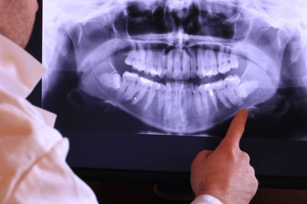 Best Knocked-Out Tooth (Avulsed Tooth) Treatment in Mount Jackson, VA